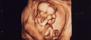 Ditengah Kegelisahan Biaya dan Covid-19, Istri Terselamatkan dan Relakan Anak Lelaki Ku